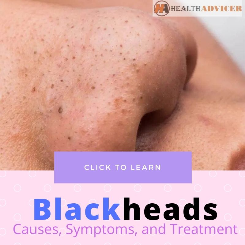 Blackheads Causes Treatment