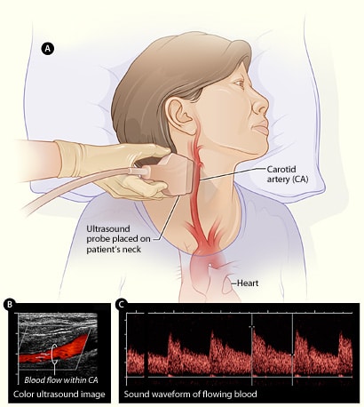 Carotid Ultrasound