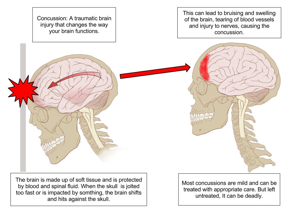 Trauma/Concussion