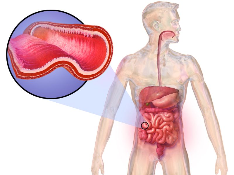 Crohn’s Disease