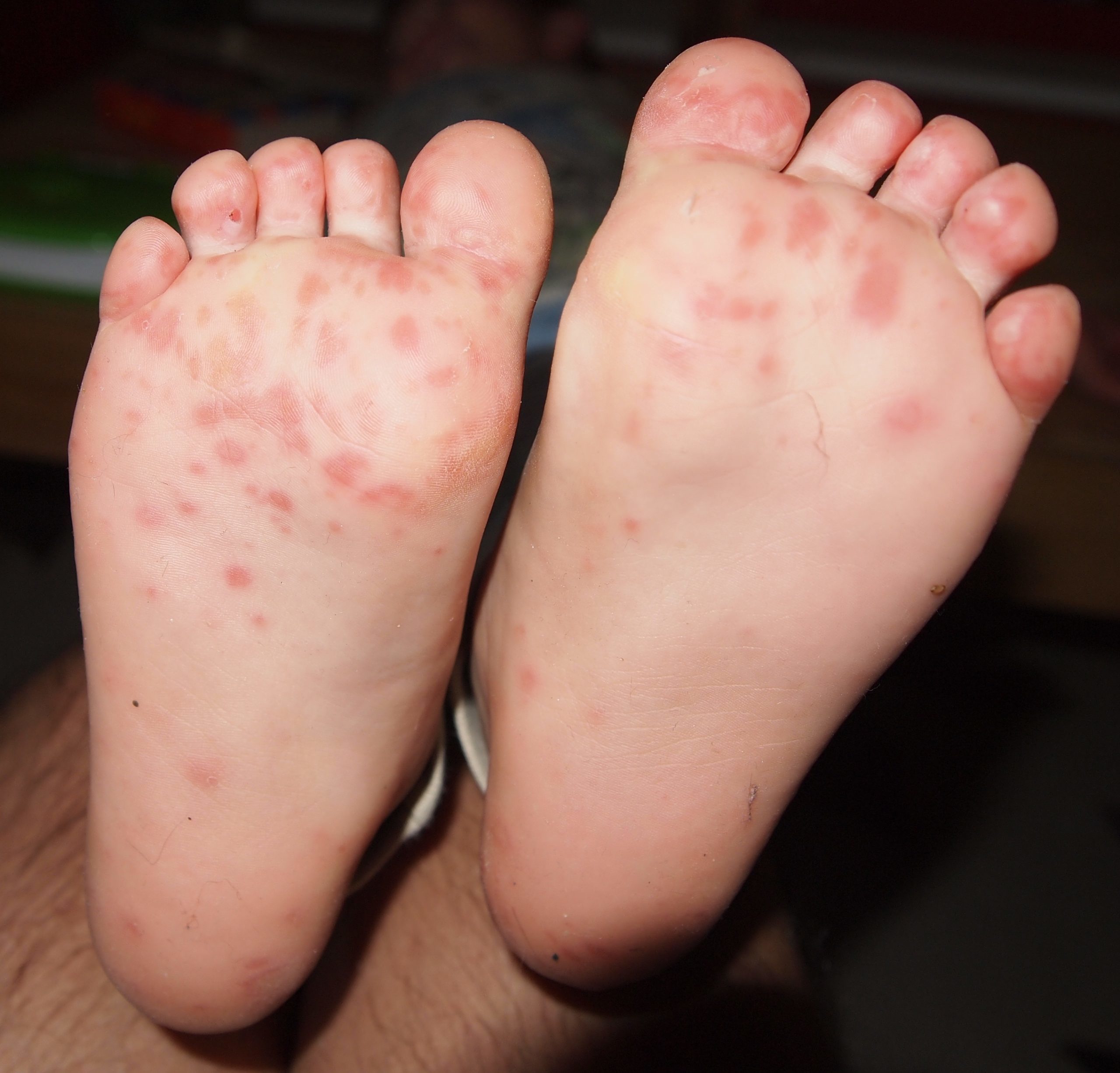 Hand Foot, And Mouth Disease