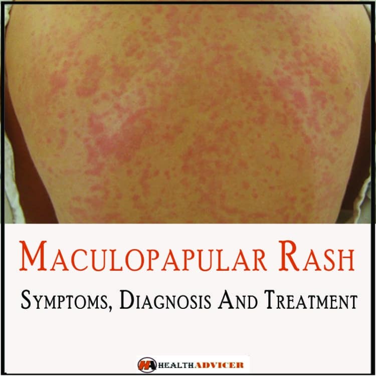 Maculopapular Rash