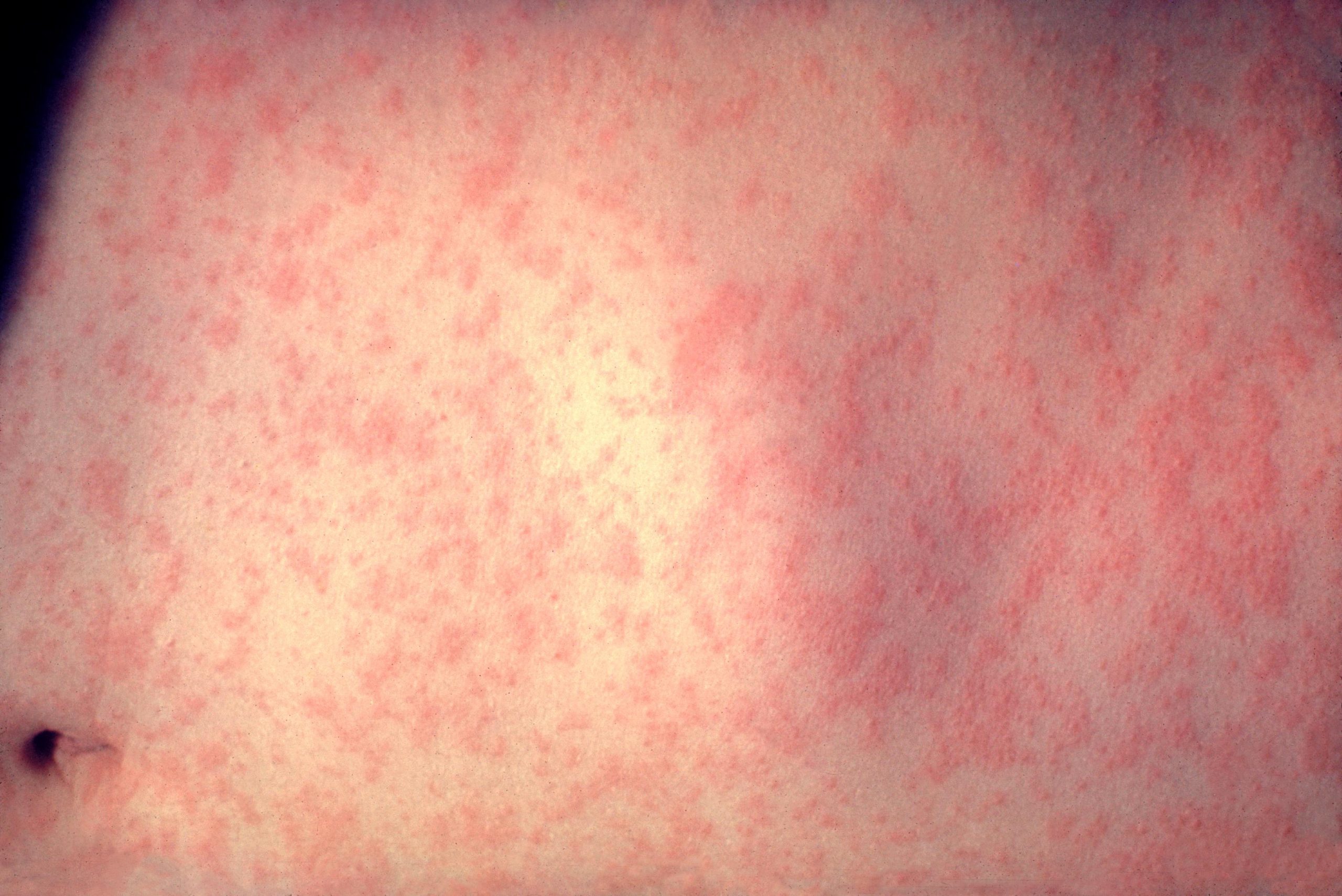 Measles