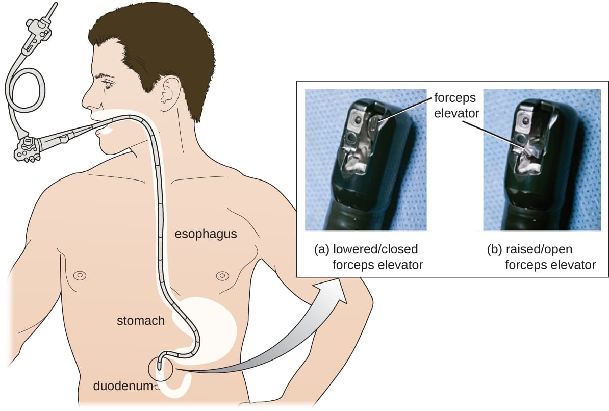 Esophagogastroduodenoscopy (EGD)