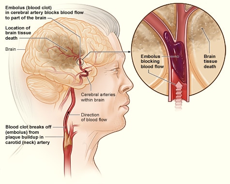 Ischemic Stroke