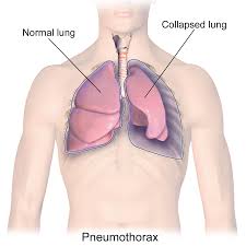 Invasive Procedures For Managing Shortness Of Breath