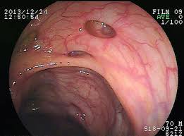 Diverticular