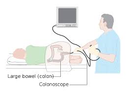 Colonoscopy/Flexible Sigmoidoscopy