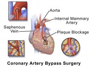 Coronary artery bypass