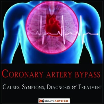Coronary artery bypass