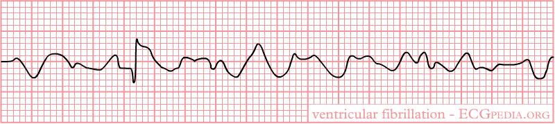  Ventricular Fibrillation