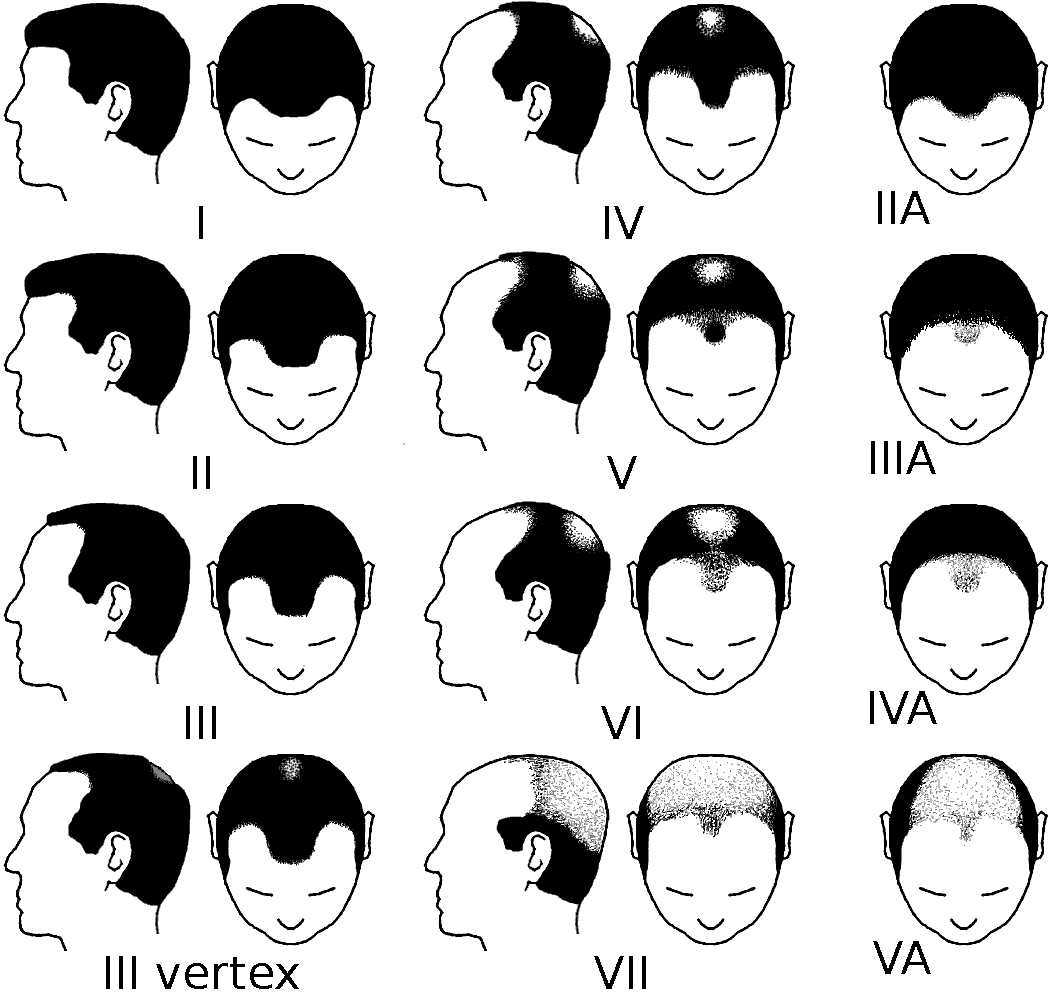 Types Of Baldness
