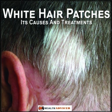 White Hair Patches