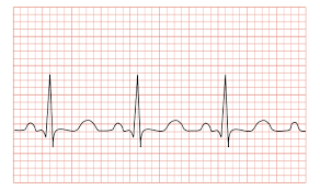 Tachycardia