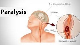 Muscle Paralysis Due To Potassium Deficiency