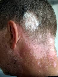 Is White Hair Patches Dangerous?