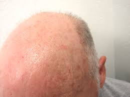 TreaHair Growth For Baldness