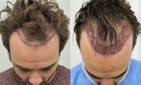 Hair Transplant Surgery