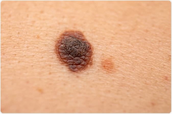 Melanoma