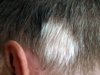 White Hair Patches