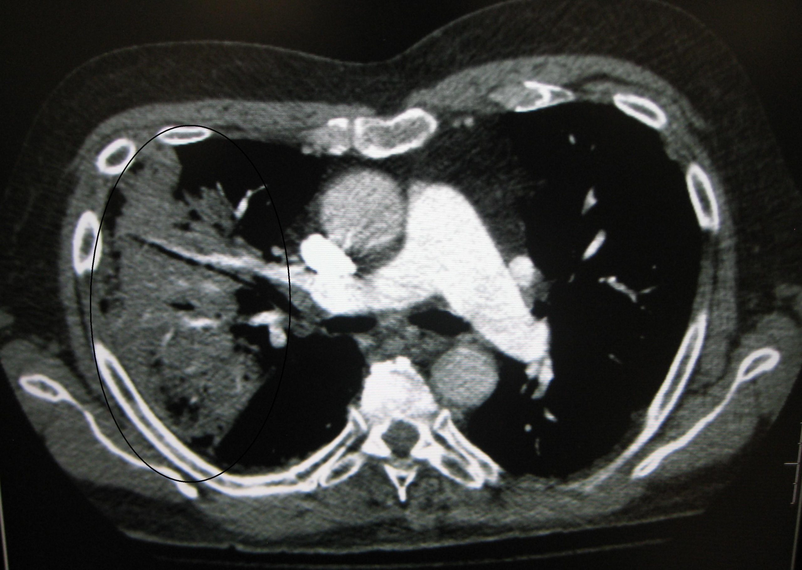 CT Chest Scan