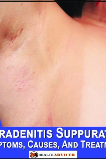 Hidradenitis Suppurativa