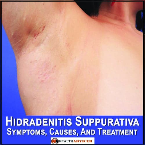 Hidradenitis Suppurativa Symptoms, Causes, And Treatment