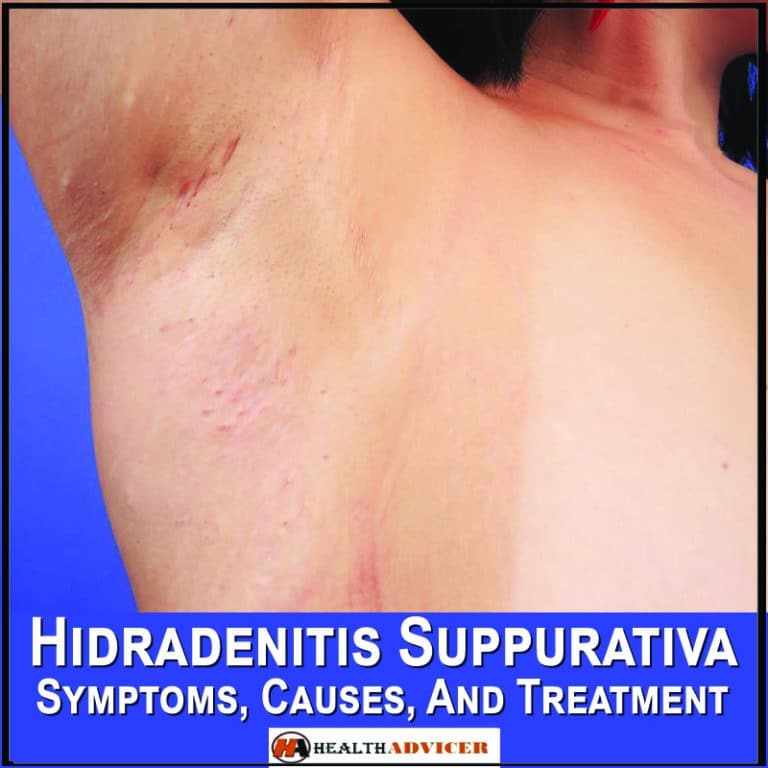 Hidradenitis Suppurativa Symptoms, Causes, And Treatment