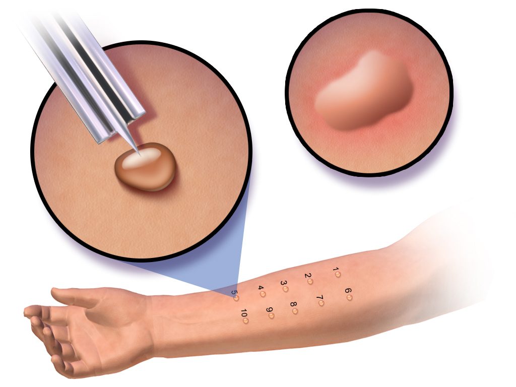 A Skin Prick Test