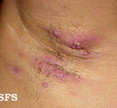 Hidradenitis suppurativa