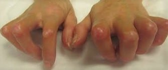 Scleroderma