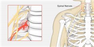 Pinched Nerve In The Neck