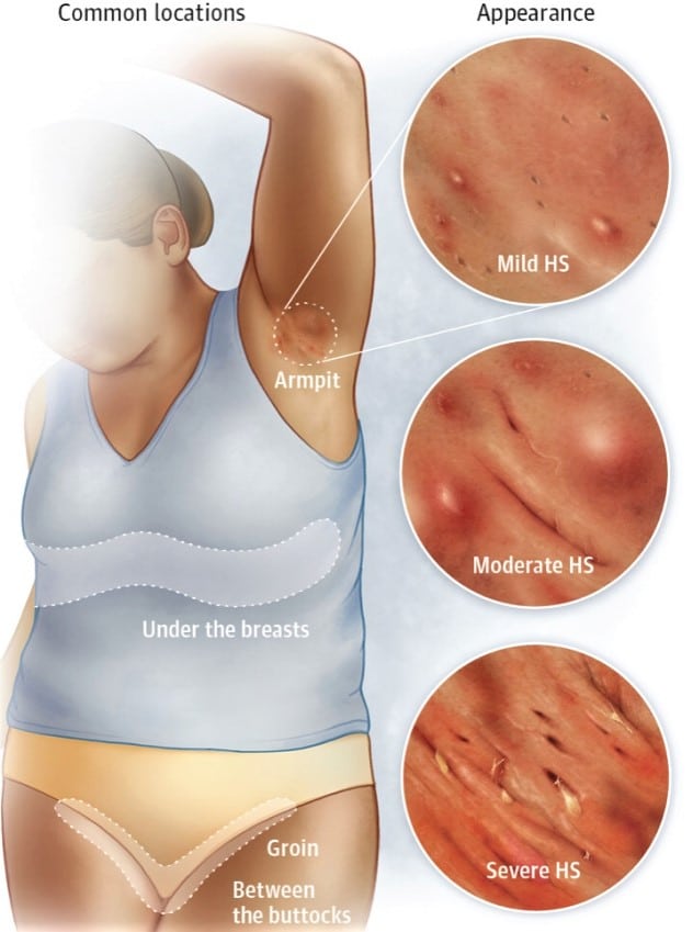 Symptoms Associated With Hidradenitis Suppurativa