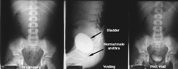 Voiding Cystourethrogram