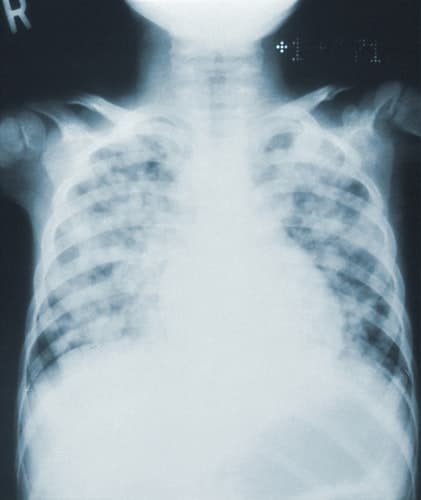 Pneumonia