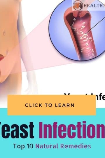 Natural Remedies for Yeast Infections